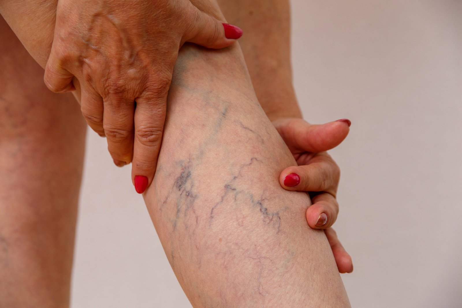 Understanding Varicose Veins: Causes, Symptoms, and Modern Treatment Options